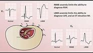 Intro to EKG Interpretation - Bundle Branch Blocks