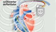 How pacemakers work