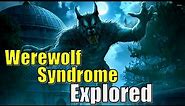 Werewolf Syndrome Explored | The disease known as Hypertrichosis Explained