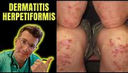 Dermatitis Herpetiformis (rash seen in Coeliac Disease aka gluten intolerance) explained...