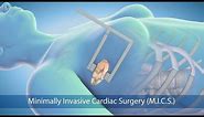 Medical Animation: Minimally Invasive Cardiac Surgery (MICS) at Sarasota Memorial Hospital