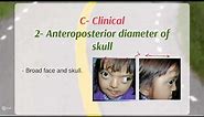 Crouzon syndrome - Definition - Etiology - Clinical