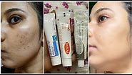 Dermatologist Recommended Best 3 Creams to remove Pimple Marks, Acne Scars, Dark Spots, PIH