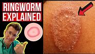 Doctor explains Ringworm (aka Tinea) including symptoms, signs, causes and treatment!
