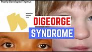 DiGeorge Syndrome - Pathology, Clinical Presentation, Diagnosis & Treatment