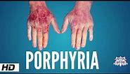 Porphyria, Causes, Signs and Symptoms, Diagnosis and Treatment.