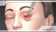 Cosmetic Surgery Animated Video | Eyelid Surgery