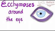 Ecchymoses around the eye