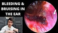 Bleeding And Bruising In the Ear Canal (Haemoglobin Breakdown Explained)