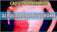 What is Acrocallosal Syndrome, Causes, Symptoms and Treatments