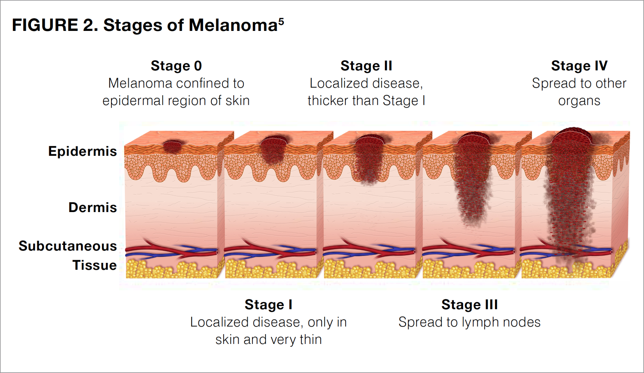 Melanoma pictures by stages, stage 0-1-2-3-4 melanoma pictures ...