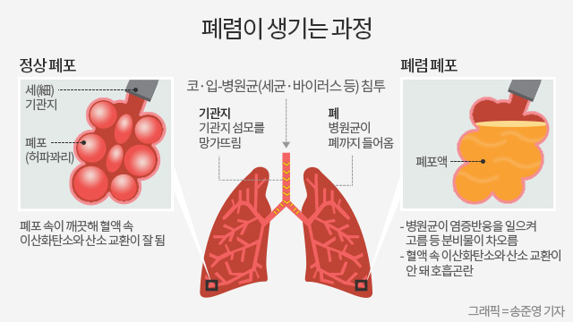 폐렴을 조심하라 - 조선닷컴 - 스페셜 > 와이드뉴스
