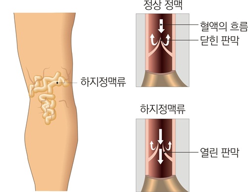하지정맥류 - 코메디닷컴