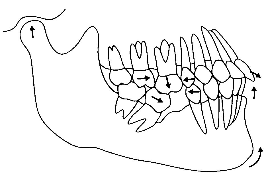 4.欠損歯