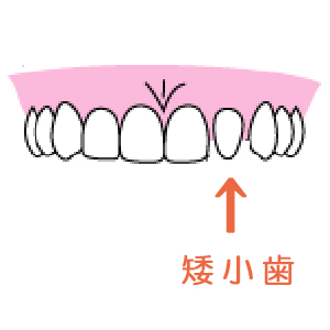 静岡市葵区の歯医者 みまつ渡辺歯科 » 歯の大きさが小さい『 矮小歯 』 について教えてください
