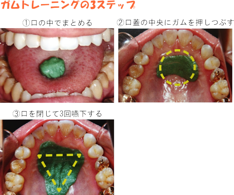 バイオセラピーの種類 | 立川・ 小児歯科の小林歯科クリニック