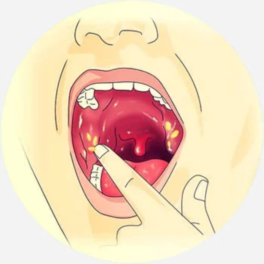 rawat tonsil
