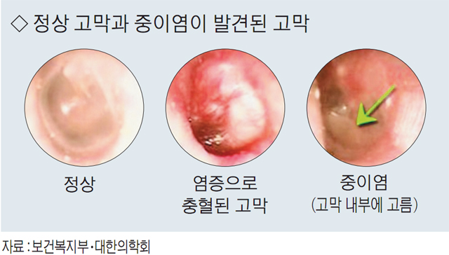 감기 앓다 걸리기 쉬운 중이염 :: 경남신문