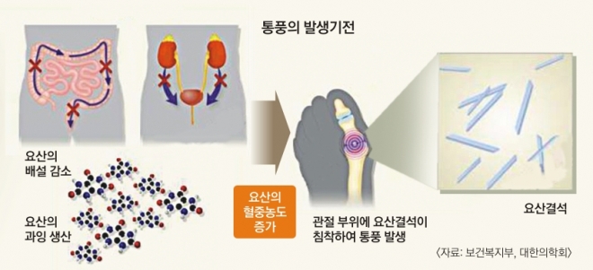 [서울신문] 발부터 노리는 몸속 칼바람 ‘통풍’… 술 대신 물 드세요