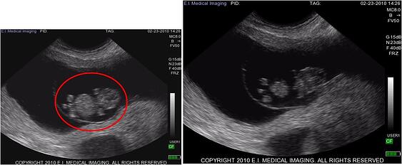 pregnancy diagnosis by ultrasound