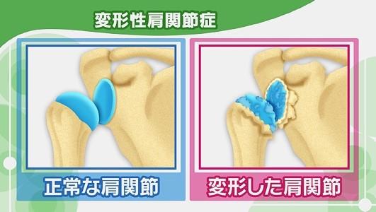 【まとめ】肩の痛み、あなたの原因は？～お悩み別解消法～ | NHK健康チャンネル