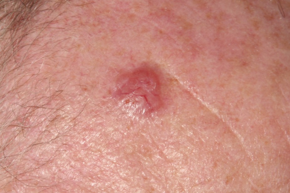 Cancer: Basal Skin Cancer