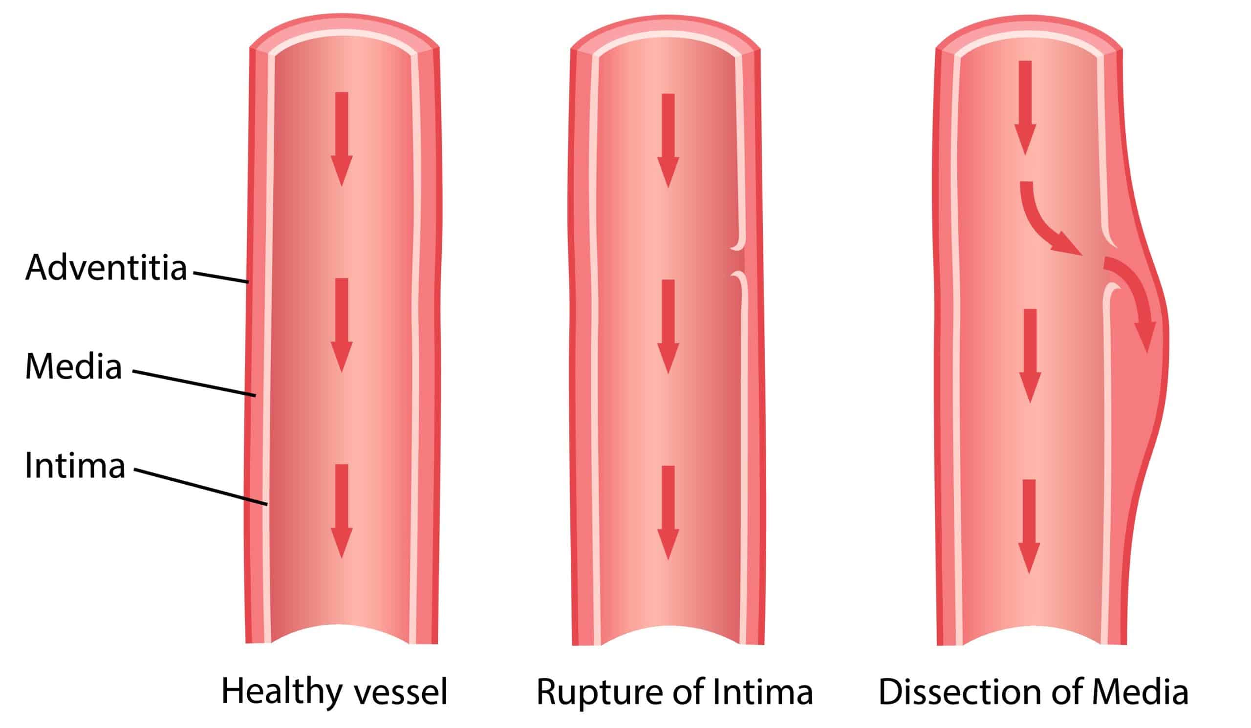 Aortic Dissection - Classification - Management - TeachMeSurgery