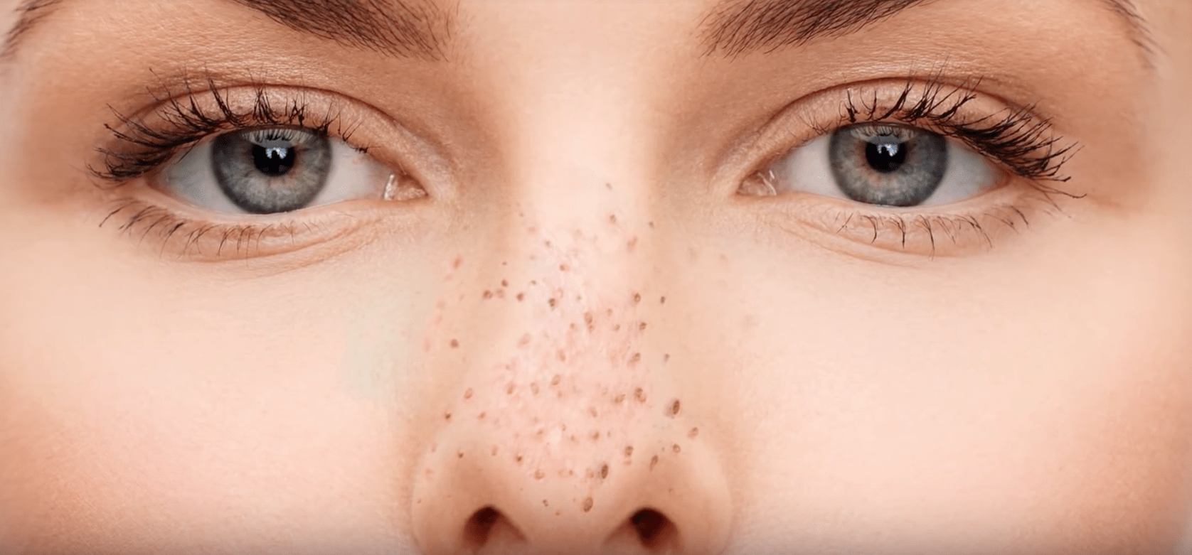 The Best Advice For Removing Blackheads From Your Nose - School Mum