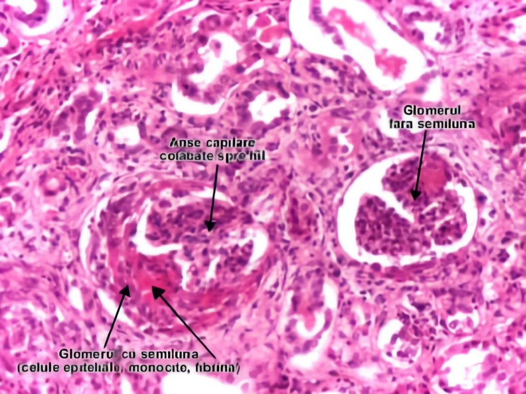 Biopsia renale - Glomerulonefrite a semilune 