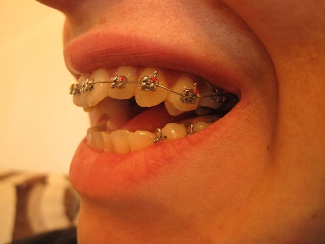 My Open Bite: Braces and Pains
