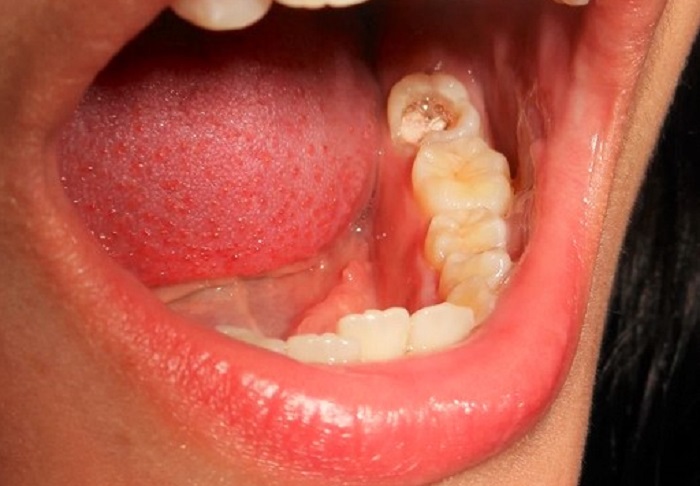 5 Fakta tentang Sakit Gigi yang Tak Bisa Diremehkan - linisehat.com