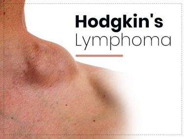 Hodgkin's lymphoma Statistics, Symptoms & Treatment - Booboone.com