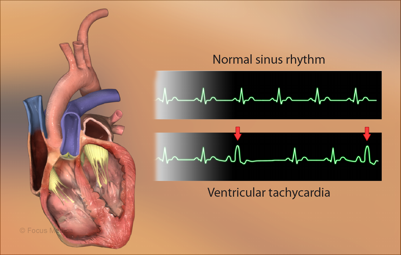 Ventricular tachycardia: Symptoms, causes, diagnosis and treatments