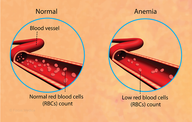 Diagrammatic Representation of Health Condition Anemia