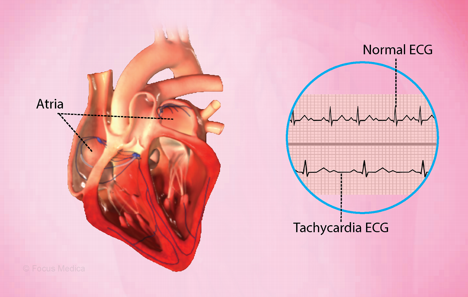 Paroxysmal Atrial Tachycardia