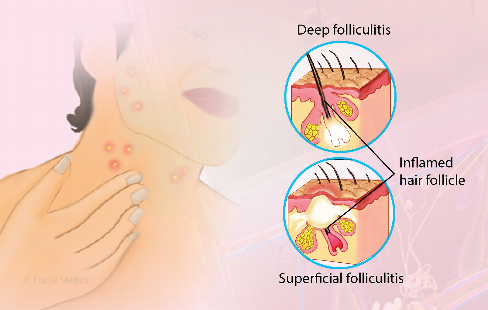 Folliculitis: Symptoms, causes, diagnosis and treatments