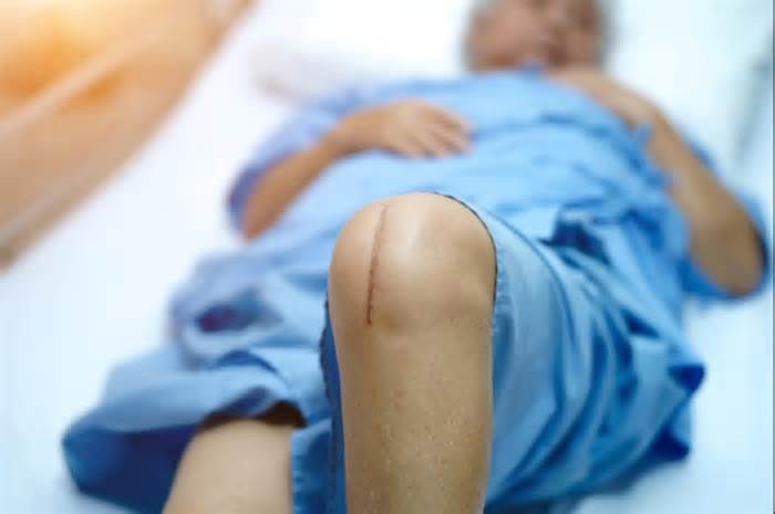According to the researchers, the rate at which U.S. patients who underwent total knee replacement required follow-up surgery is expected to rise by up to 182% by 2030.