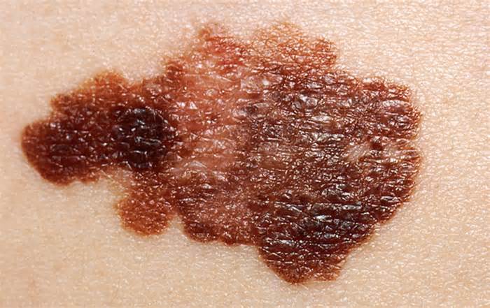 Close up of skin cancer Melanoma on a patient's skin
