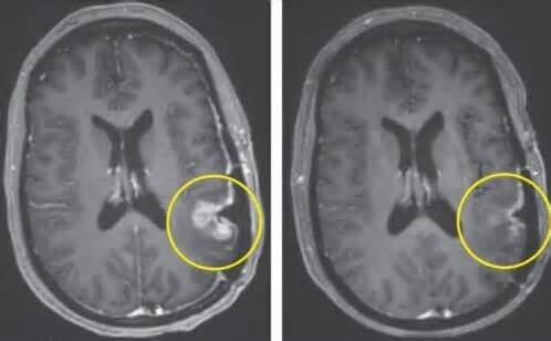 Cancer breakthrough sees brain tumour almost disappear in just five days