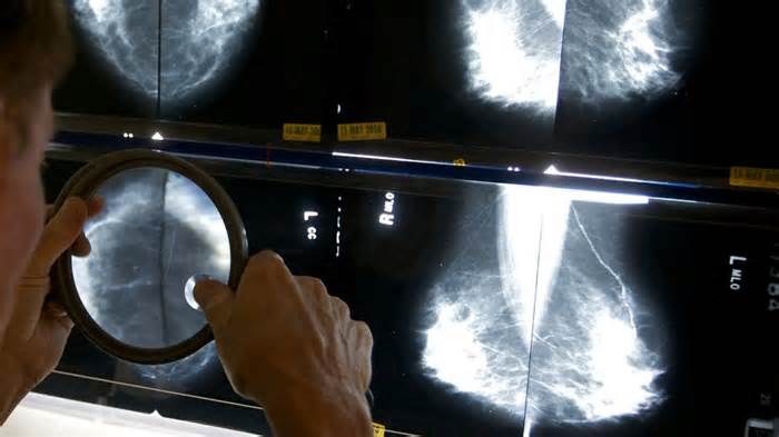 A radiologist uses a magnifying glass to check mammograms for breast cancer. - Damian Dovarganes/AP