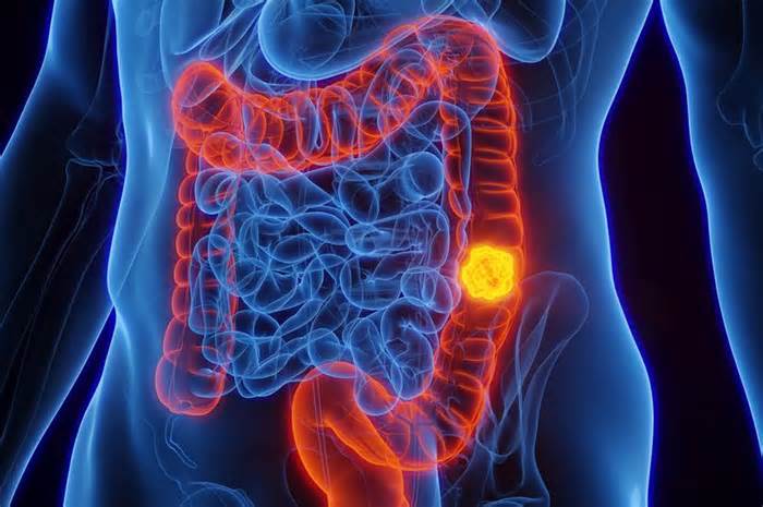 Colon cancer is reportedly on the rise among young adults