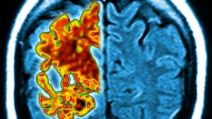 NHS exploring Alzheimer's disease blood tests