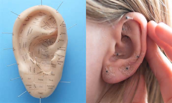 What are ear seeds, and how do they work?