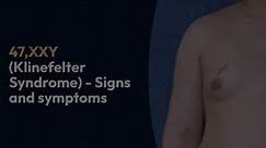47,XXY Klinefelter Syndrome | KS - XXY male | Signs & Symptoms