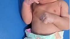Big nose small chest freezer 🤢😔 newborn baby unhealthy baby now in treat dr when he born.​