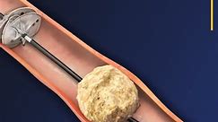 Animation Shows Kidney Stone Removal