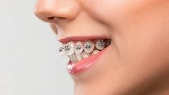 What is an Overbite? Braces & Surgery for Correction - Dentaly.org