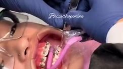Types of braces you can choose #TypesofBraces #bracestypes #bracesmetalic #braces | Braces Shop Online