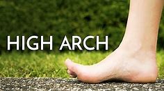 High Arch Feet (Cavus Foot) - Podiatrist Georgina Tay, East Coast Podiatry