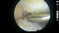 Knee Procedure: ArthroFree